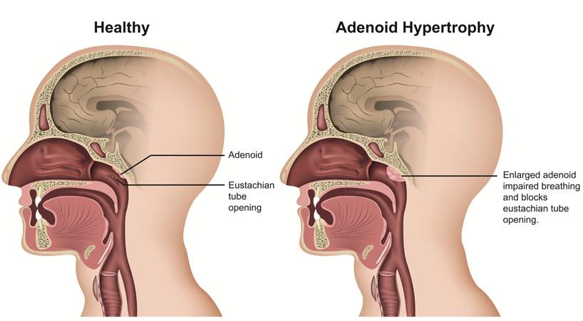 adenoidectomy
