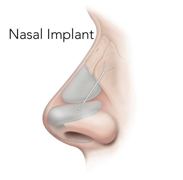 nasal implant