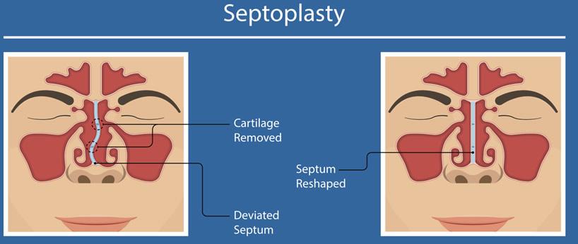 septoplasty